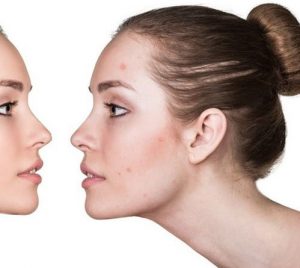 女生说长痘痘了怎么安慰能得到她好感?-泡学网-奕声情感,PUA,展示面,撩妹,聊天,情感挽回,泡学书籍,迷男方法,泡学网白鹤,搭讪,恋爱技巧,泡妞秘籍,社交软件,怎么追女生